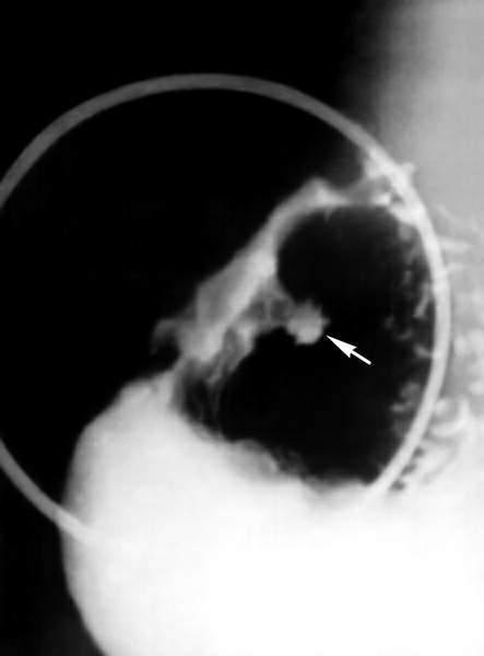Прямые и косвенные рентгенологические признаки язвы желудка