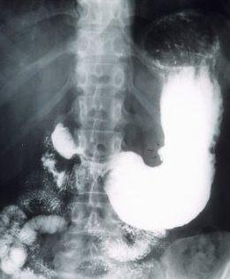 Прямые и косвенные рентгенологические признаки язвы желудка