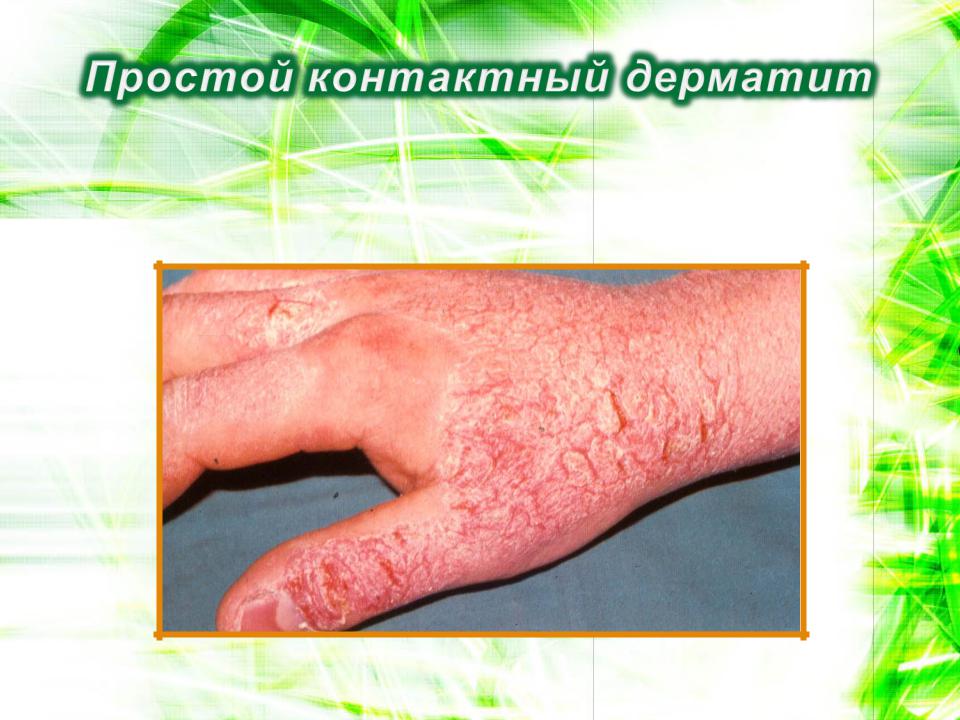 патогенез контактного дерматита включает презентацию антигена