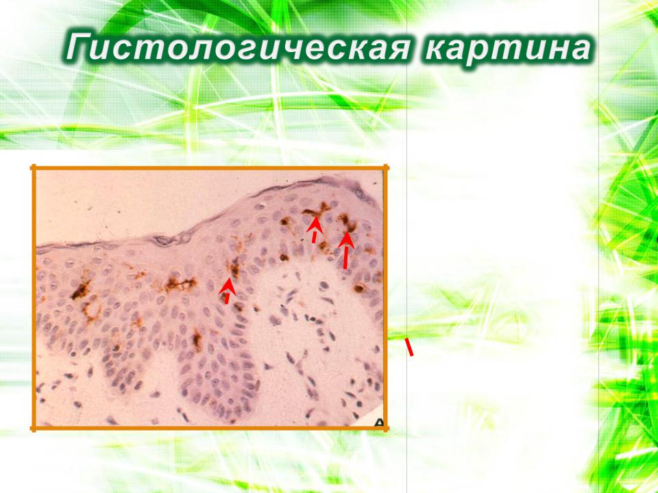 патогенез контактного дерматита включает презентацию антигена