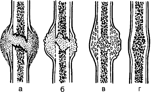 источники формирования костной мозоли thumbnail