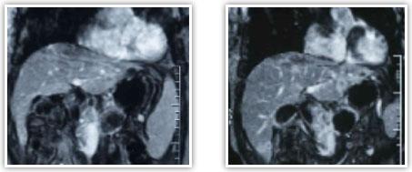 Верификация опухоли поджелудочной железы