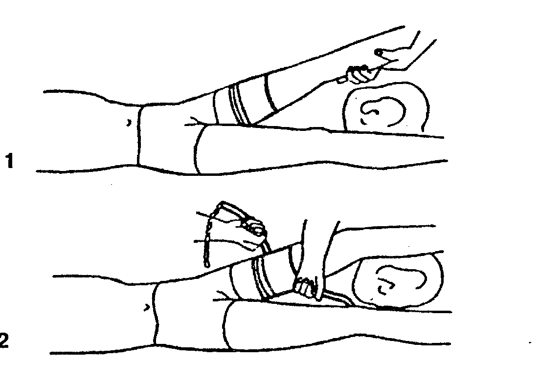 Повязка дезо на плечевой сустав