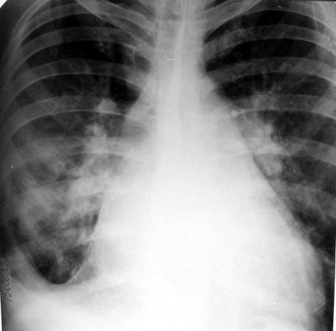 Порок сердца на рентгенограмме