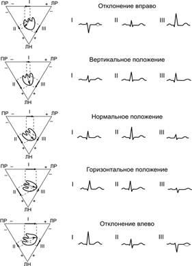 Определение электрической оси сердца по ЭКГ